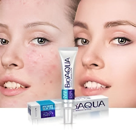 Bioaqua Acne Cream | Bio Aqua Removal Of Acne